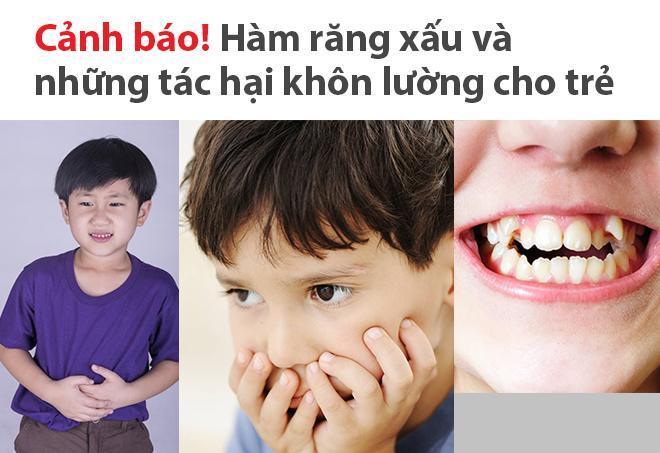 Răng hô hàm là dạng sai lệch khớp phức tạp, nếu không sớm điều trị kịp thời, có thể gây ra nhiều tác hại xấu