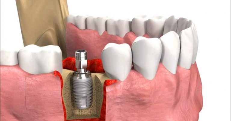 Khi phát hiện răng giả bị lung lay, bạn nên đến trực tiếp cơ sở nha khoa uy tín để được kiểm tra