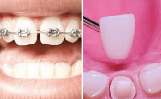Răng lệch lạc, nên niềng răng hay bọc sứ ?