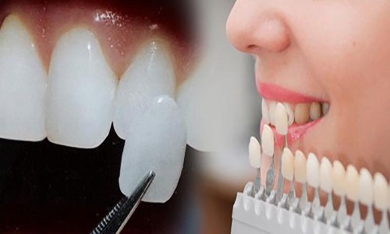 Đắp răng sứ là phương pháp dùng vật liệu sứ mỏng phủ bên ngoài mặt răng