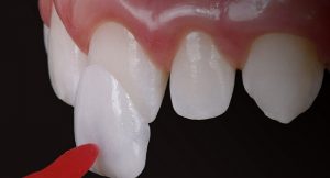 Dán răng sứ thẩm mỹ là gì? Những ưu điểm của dán răng sứ
