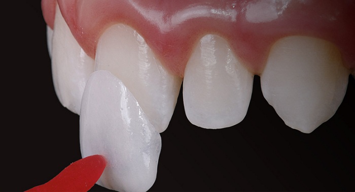 Dán răng sứ sử dụng mặt dán sứ có độ mỏng từ 0.2 mm - 0.5mm