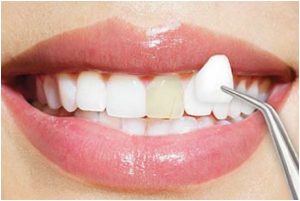 Bọc răng sứ không cần mài răng nhỏ lại? Có thật sự không mài?