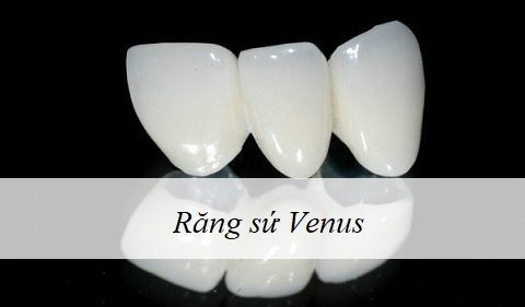 Răng sứ Venus là gì? Tại sao răng này không còn được ưa chuộng? 