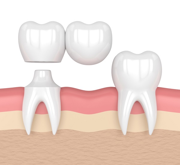 Cầu Răng Sứ Là Gì Ưu Và Nhược Điểm Cần Biết Khi Làm Cầu Răng Sứ (1)