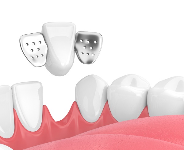 Cầu Răng Sứ Là Gì Ưu Và Nhược Điểm Cần Biết Khi Làm Cầu Răng Sứ (2)