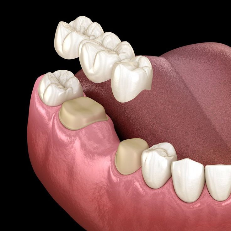 Cầu Răng Sứ Là Gì Ưu Và Nhược Điểm Cần Biết Khi Làm Cầu Răng Sứ (4)