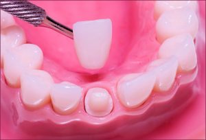 Bọc răng sứ bị hở - Nguyên nhân và cách khắc phục