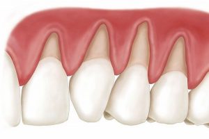 Bọc răng sứ bị tụt lợi - Nguyên nhân và cách khắc phục là gì?