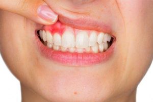 Bọc răng sứ bị viêm lợi - Nguyên nhân và cách khắc phụcBọc răng sứ bị viêm lợi - Nguyên nhân và cách khắc phục