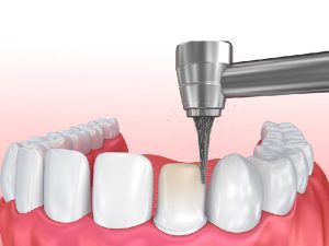 Quy trình bọc răng sứ bao lâu? Bao gồm những công đoạn gì?