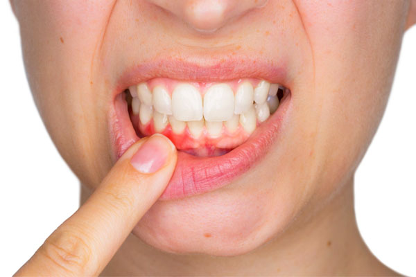 Bọc răng sứ có bị đau không ?