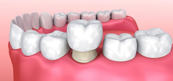 Bọc răng sứ có tốt không? 7 lợi ích tuyệt vời từ bọc răng sứ?