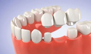 Cầu răng sứ là gì? Ưu và nhược điểm khi làm cầu răng sứ