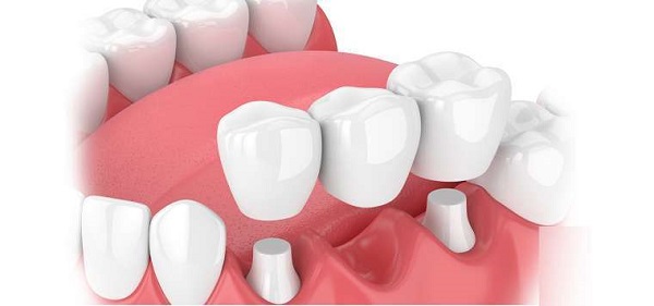 Cầu răng sứ là gì?