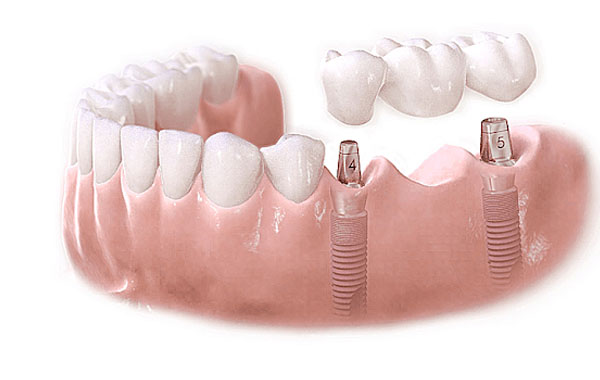 Cầu răng sứ có bền không?