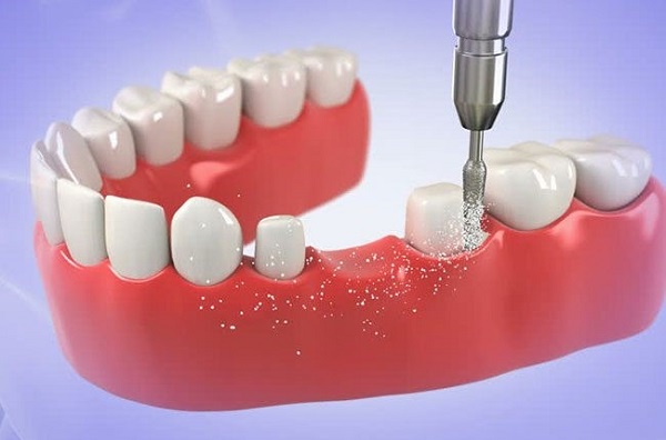 Nhược điểm của phương pháp cầu răng sứ