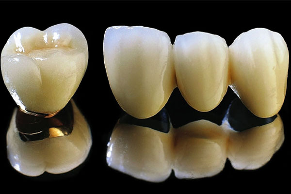 Bọc răng sứ bị hôi – Nguyên nhân do đâu?