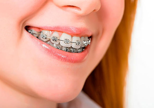 Có thể Áp dụng niềng răng chỉnh nha để khắc phục cười hở lợi