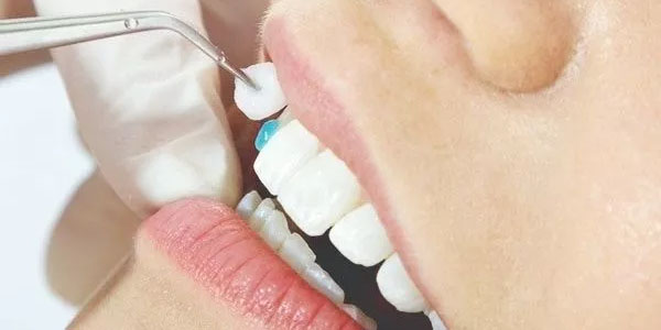 Các yếu tố ảnh hưởng đến thời gian bọc răng sứ