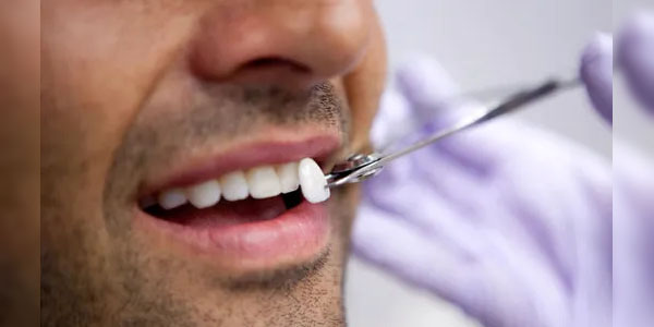 Quy trình làm răng sứ Lumineers?