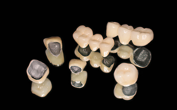 Răng sứ kim loại thường là gì? Răng sứ kim loại thường có tốt không?