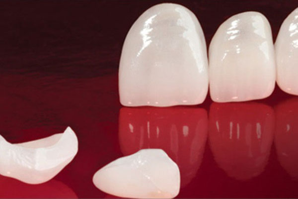 Răng sứ Lumineers là gì? Dán răng sứ Lumineers có tốt không?