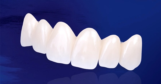Răng toàn sứ là loại răng có cấu tạo lớp sườn bên trong và lớp men bên ngoài được làm hoàn toàn bằng sứ