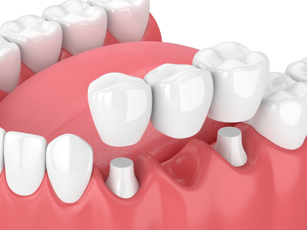 5 Loại Cầu Răng: Loại nào phù hợp với bạn nhất?