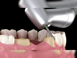 Bọc răng sứ bị cộm - Nguyên nhân và cách khắc phục