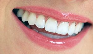 Bọc răng sứ bị đen nướu - Nguyên nhân và cách khắc phục