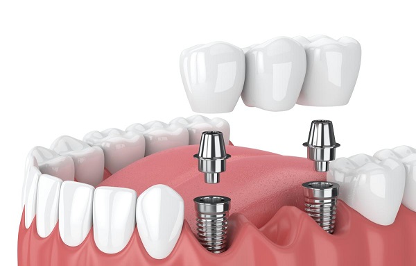 Kết hợp Implant làm cầu răng (Implant Supported Bridges)