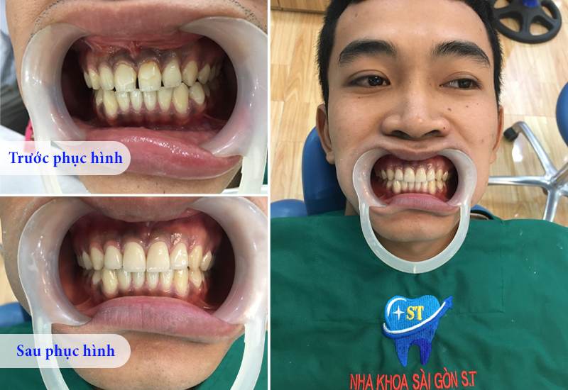 Thẩm mỹ răng sứ mang đến hàm răng đều đẹp và tiết kiệm thời gian điều trị