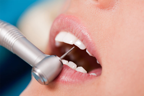 Mài xương ổ răng là gì? Có ảnh hưởng đến sức khỏe hay không?