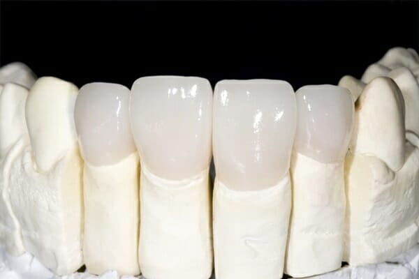 Răng sứ cercon HT là gì?