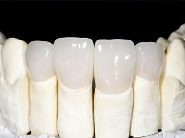 Răng sứ Emax là gì?