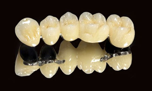 Cầu răng sứ Titan
