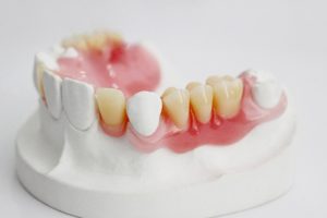 Răng tháo lắp Composite có tốt không? Giá bao nhiêu?