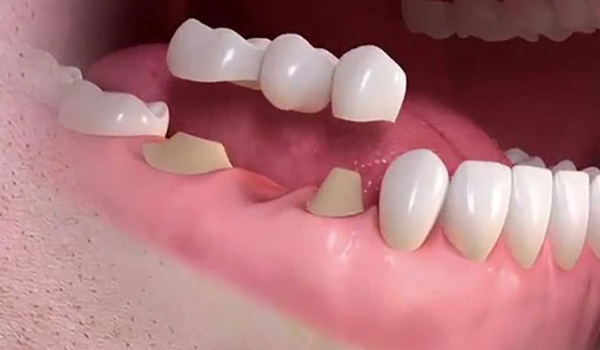 Trồng răng hàm số 6 bằng cầu răng sứ