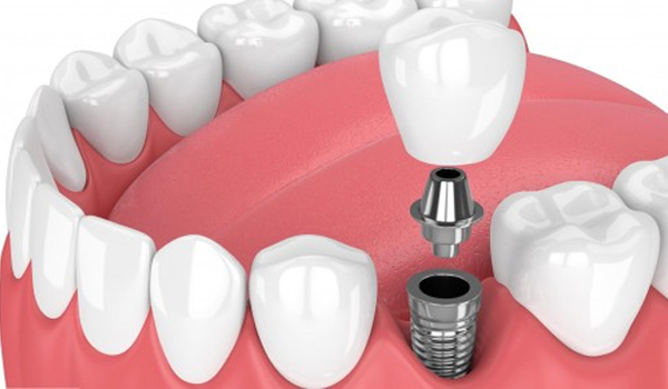 Trồng răng hàm số 6 bằng Implant