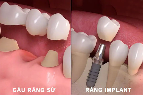 Cấy Ghép Implant Là Gì Những Điều Cần Biết Trước Khi Thực Hiện (2)