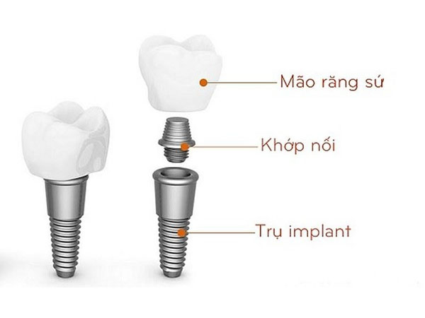 Cấy Ghép Implant Là Gì Những Điều Cần Biết Trước Khi Thực Hiện (3)