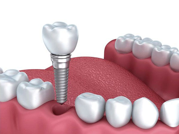 Công nghệ cấy ghép trồng răng Implant là gì?