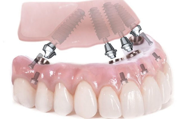 Phần răng sứ được chế tác với màu sắc như răng thật nâng cao tính thẩm mỹ
