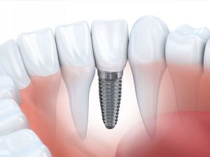 Quá trình trồng răng Implant có đau không?