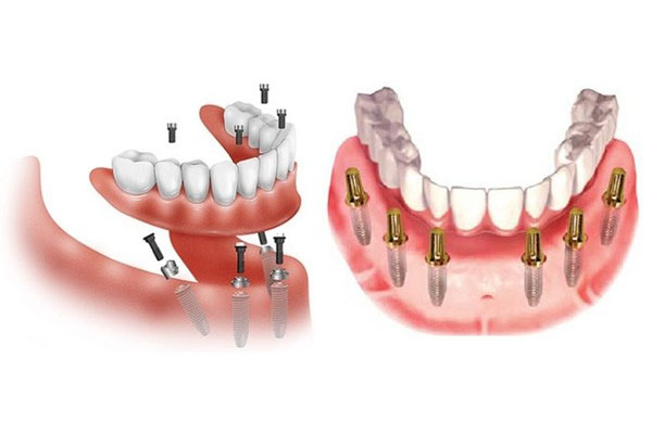 Kỹ thuật trồng răng Implant nguyên hàm all on 4 và all on 6