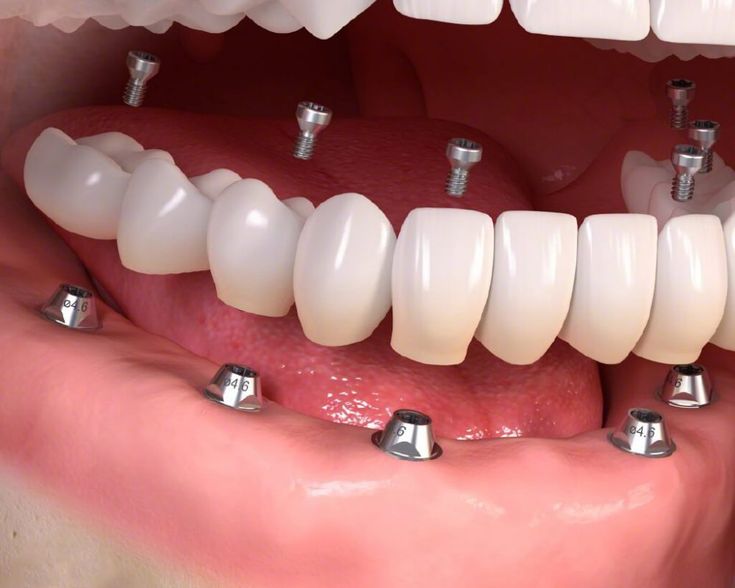 Trồng Răng Implant Trả Góp Lãi Suất 0% Tại Nha Khoa Sài Gòn St