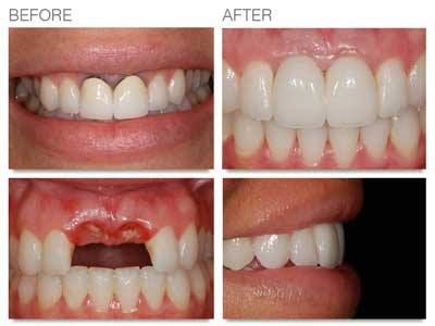 Trồng Răng Implant Trả Góp Lãi Suất 0% Tại Nha Khoa Sài Gòn St