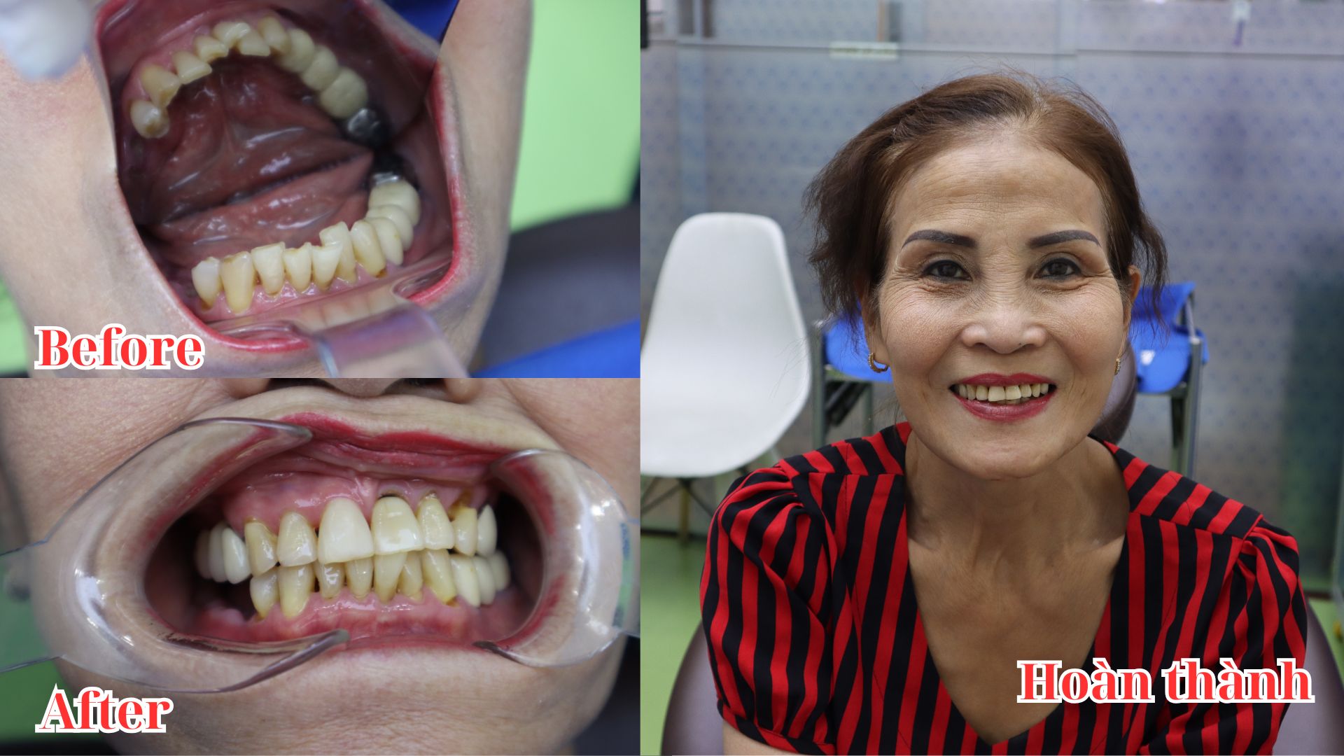 Trồng Răng Implant Trả Góp Lãi Suất 0% Tại Nha Khoa Sài Gòn St