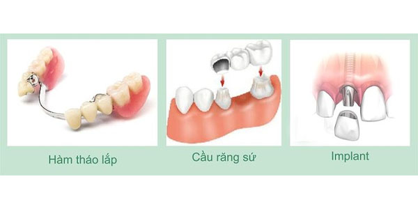 So sánh các giải pháp trồng răng 
